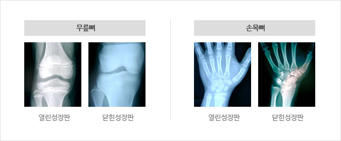 무릎뼈, 손목뼈 X-ray