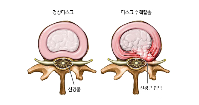 추간판탈출증이란