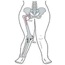 X형 다리 (외반슬,knock-knee)