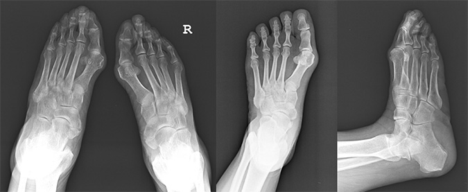 무지외반증 X-RAY